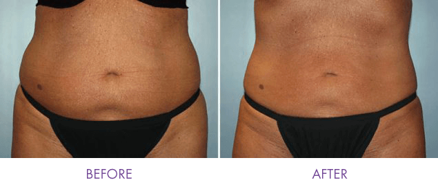 CoolSculpting Elite, reducing fat to sculpt her waist, before and