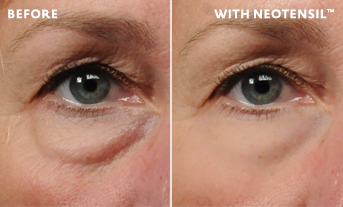 Lower Blepharoplasty Before and After Gallery  Taban MD