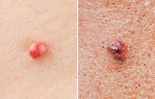 pre cancer skin spots