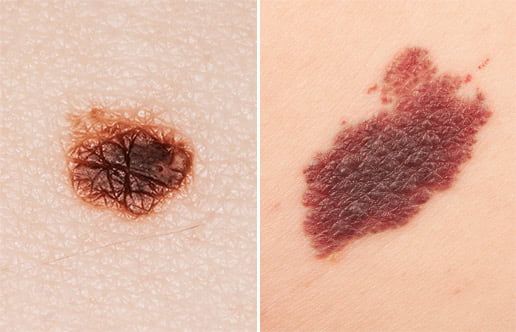 Skin Cancer Examples 