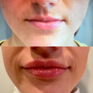 Lip Enhancement - Fillers & BOTOX in Reading - Berks Plastic Surgery