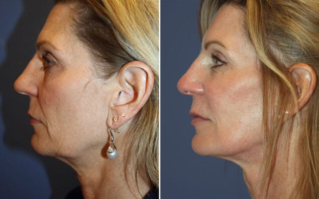 Reading Facelift Surgery
