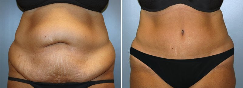 What To Expect With Tummy Tuck Recovery