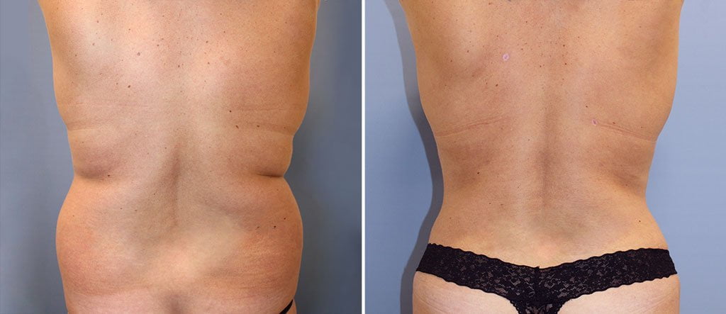 Post Leg Liposuction Recovery Surgical High