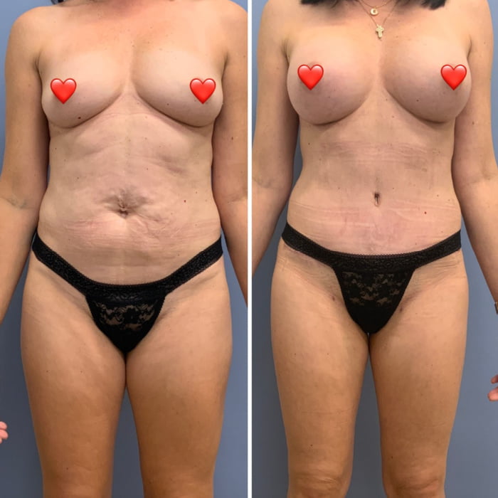 Mom shown before and after breast augmentation with Dr. Reedy