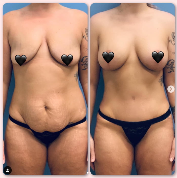 Mom is shown before and breast augmentation with tummy tuck and liposuction