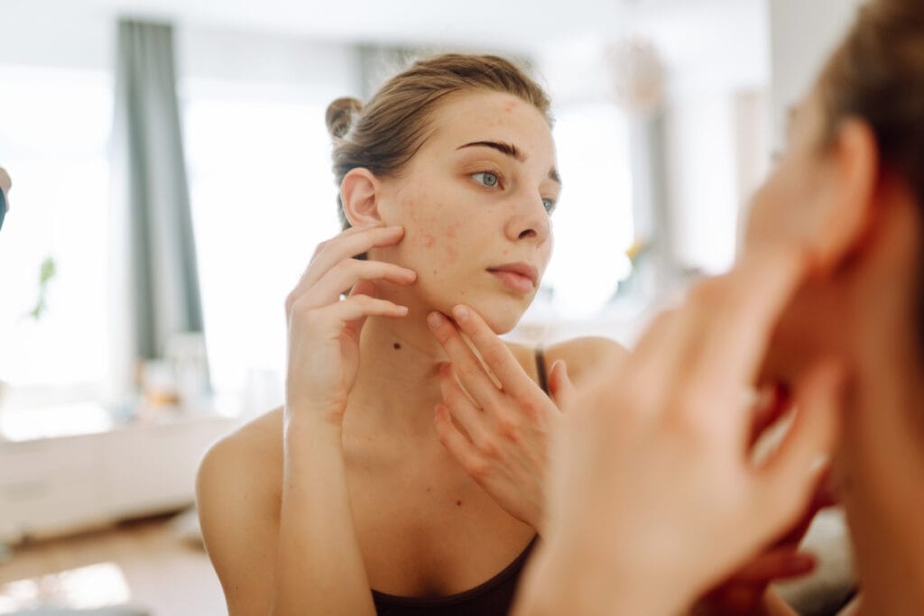 Woman frowning at cheek acne in the mirror